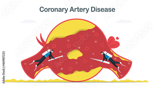 Coronary artery disease treatment that caused by atherosclerosis. More cholesterol and fatty deposits in blood vessel. Cardiology vector illustration isolated on white background.