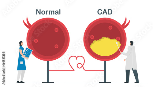 Comparison of Normal heart and Coronary artery disease.Cardiology vector illustration isolated on white background.