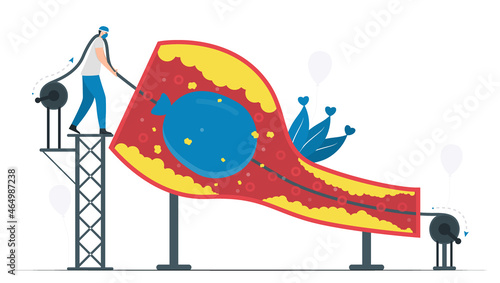 This disease is narrowing of coronary arteries. Balloon angioplasty uses to improve blood flow of vessel. Cardiology vector illustration.