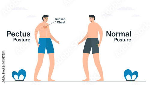 Comparison of normal and pectus posture. Pectus excavatum has a sunken chest. Pulmonology vector illustration about restrictive lung disease.