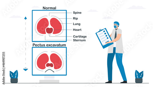 Doctor checks a pectus excavatum that is a structural deformity of anterior thoracic wall. Sternum and rib cage are shaped abnormally. Pulmonology vector illustration about restrictive lung disease.
