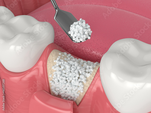 3D render of dental bone grafting with bone biomaterial application photo