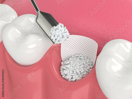 3D render of dental bone grafting with bone biomaterial and membrane photo