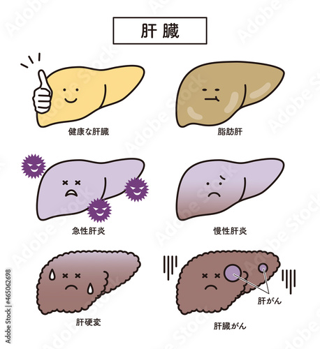 シンプル　イラスト　肝臓　脂肪肝　慢性肝炎　急性肝炎　肝硬変　肝臓がん