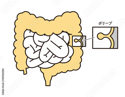シンプル　イラスト　大腸にできたポリープ