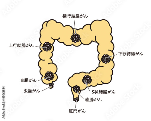 シンプル　イラスト　大腸のがん発生部位
