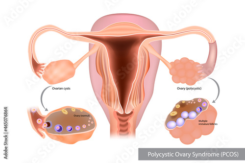 Polycystic Ovary Syndrome PCOS. Multiple immature follicles or Ovarian cysts. Reproductiv. photo