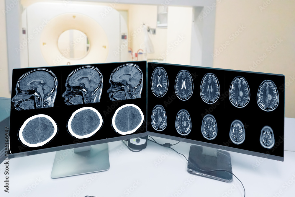 Close up CT-scan control room and showing brain image meningioma in brain  CT scan room background, Medical healthcare, and technology concept. Stock  Photo | Adobe Stock
