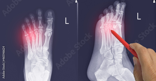 Tableau sur toile Close up X-ray Foot  AP-Lateral showing fracture 3th,4th metatarsal bone, Doctor holding a red pen point , symptoms medical healthcare concept