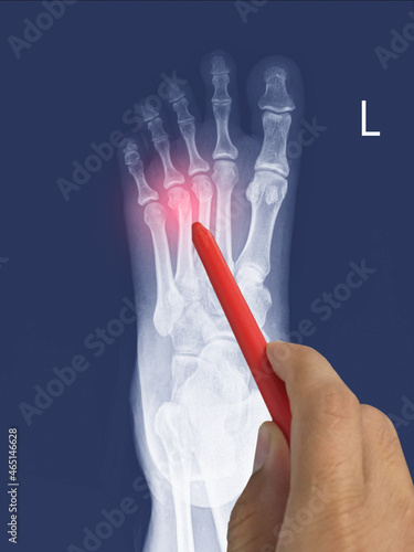 Obraz na plátne Close up X-ray Foot  AP-Lateral showing fracture 3th,4th metatarsal bone, Doctor holding a red pen point , symptoms medical healthcare concept