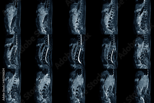 Lumbar spinal stenosis MRI scan Sagittal view finding moderate posterior inferior tumor protrusion cause bilateral root compression. Chronic low back pain disease photo