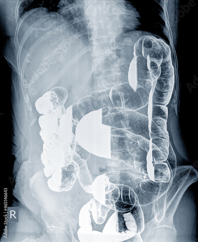 Radiological examination to look for colon abnormalities By enema the barium powder and air into the anus. Then x-ray was done. Medical image concept.