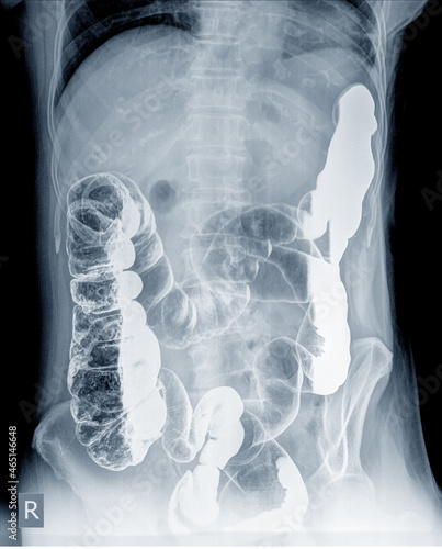 Photos Radiological examination to look for colon abnormalities By enema the barium powder and air into the anus