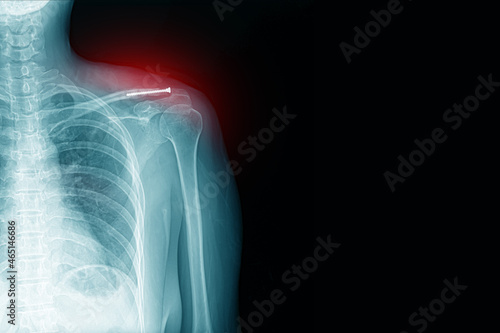 x-ray image of shoulder pain with clavicle fracture with post-op and screw medical healthcare concept.copy space