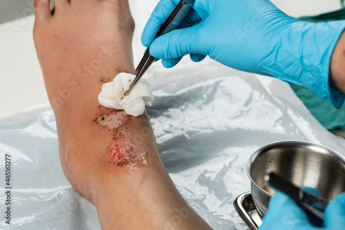 close up doctor cleaning wound on leg, Injuries from falling