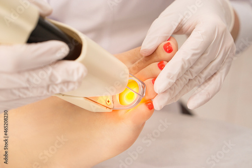close-up of the doctor's hands doing laser epilation Adeksatdritovy ray burns hair epilation on the toes.