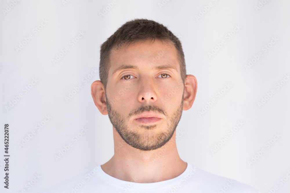 Lop-eared man, big ears. Ears defect. Patient before plastic surgery. Waiting for otoplasty Lop-eared man, big ears. Ears defect. Patient before plastic surgery. Waiting for otoplasty