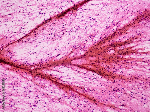 Billede på lærred Fine needle aspirate cytology of metastatic melanoma, with large malignant cells