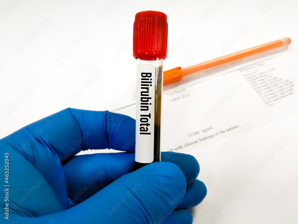 Blood sample tube for Bilirubin Total test. To diagnosis jaundice Stock Photo Adobe Stock