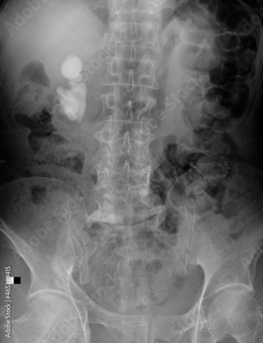 x ray image of renal stone,kidney stone,nephrolithiasis photo