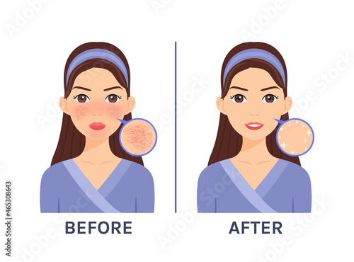 Couperose. Skin Disease, Problem on Beautiful Cartoon Female Face. Treatment of Rosacea. Red Unhealthy skin. Zoom. Before, After. White background. Illustration for Beauty, Medical Design. Vector photo