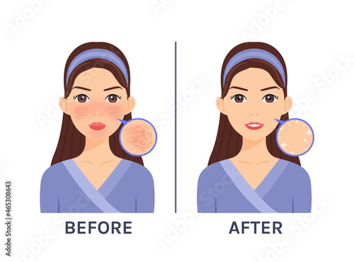 Couperose. Skin Disease, Problem on Beautiful Cartoon Female Face. Treatment of Rosacea. Red Unhealthy skin. Zoom. Before, After. White background. Illustration for Beauty, Medical Design. Vector