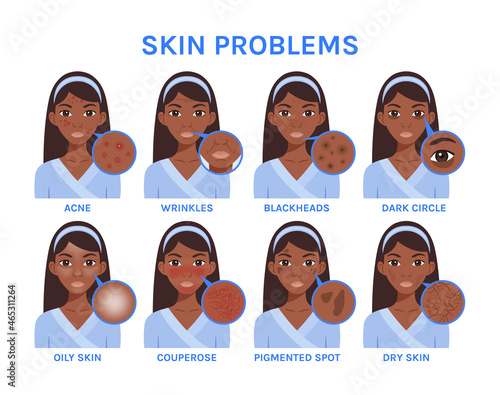 Black African Woman with Skin Problems. Close up of Pimples, Blackheads, Wrinkles and Age Spots. On a Face, Dry and Oily Skin, Rosacea, Couperose. Dark Circles under the Eyes. Image for Beauty Design.
