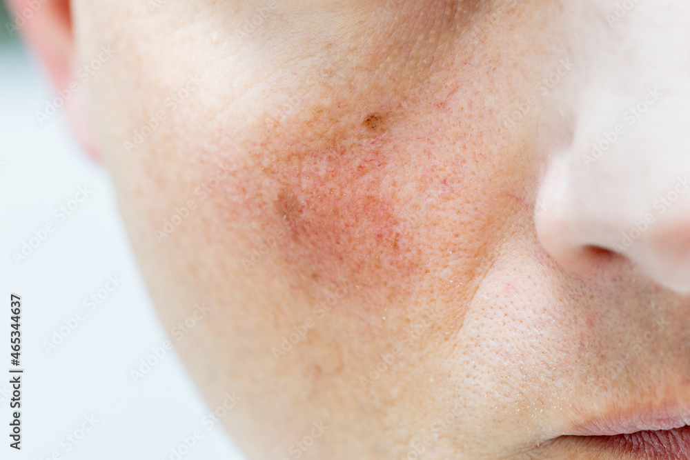 Red face, broken blood vessels, health problems