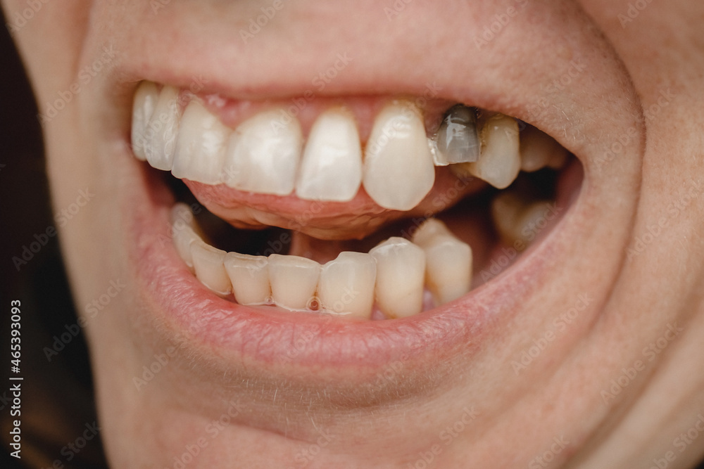Fototapeta premium An open mouth with teeth, one of which is black and broken. Dentistry