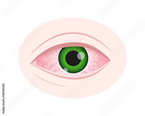 Eye irritation. Inflamed bloodshot eyeball with red conjunctiva isolated on white background. Symptom of keratitis, allergy, conjunctivitis, uveitis. Vector cartoon illustration.