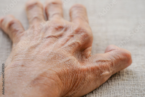 Obraz na plátně a fossa between index finger and thumb on an old man hand from muscles atrophy,