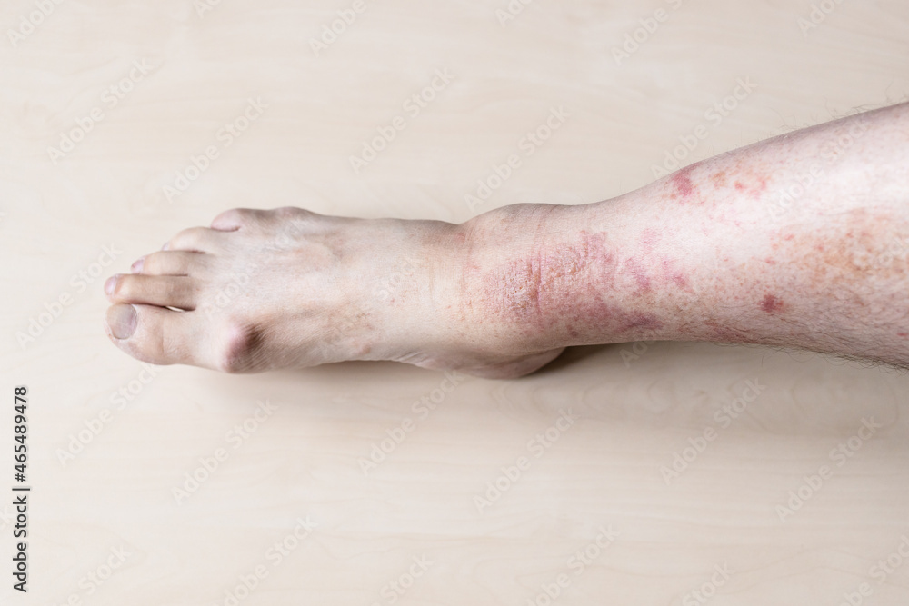 sample of Allergic contact dermatitis male shin with itchy red rash