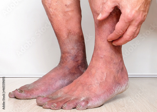 suffering from varicose veins photo