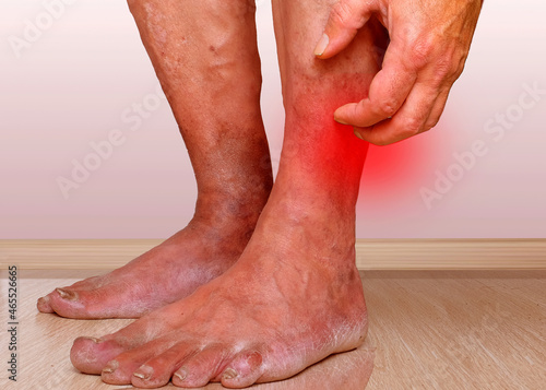 Sharp pain, inflammation and itching of damaged skin.