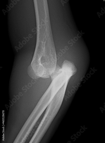 x ray of a elbow dislocation