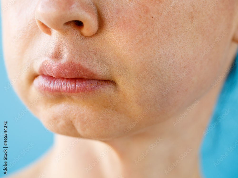 Teeth Problem. Gumboil, flux, bruise and swelling of cheek. Closeup Of