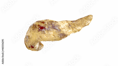 Pancreatitis disease of human pancreas isolated on white. Acute hemorrhagic pancreatitis with fatty necrosis of pancreas. 3d illustration  photo