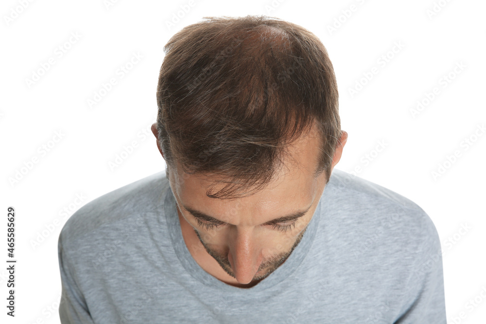 Obraz premium Man with hair loss problem isolated on white, above view