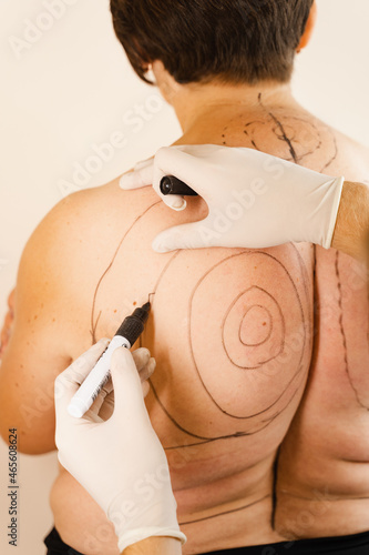 Canvas Print Markup fat woman before kyphosis surgery