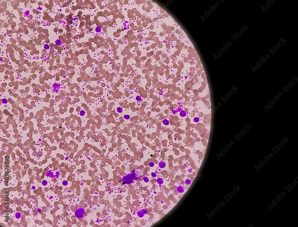 Thrombocythemia, Essential thrombocytosis blood smear, present abnormal ...