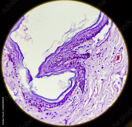 Photomicrograph (microscopic image) from breast mastectomy specimen showing phyllodes tumor (cystosarcoma phylodes) photo