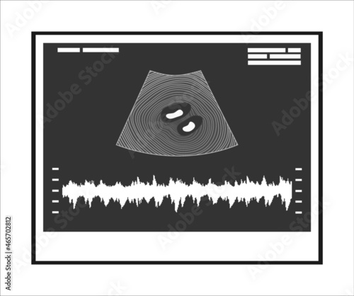 Photos Twin pregnancy ultrasound. Multiple pregnancy.