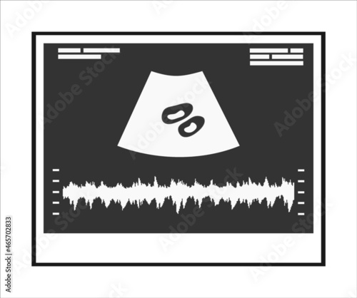 Ultrasound of a twin pregnancy