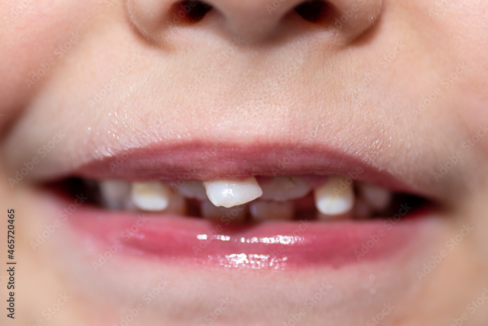 Naklejka premium Little boy with open mouth showing milk teeth in front and growing permanent teeth.