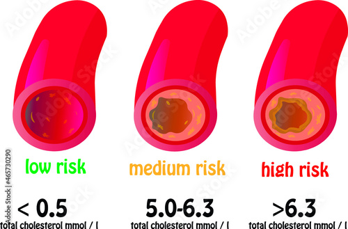 cholesterol plaques in the vessels and the degree of blockage 