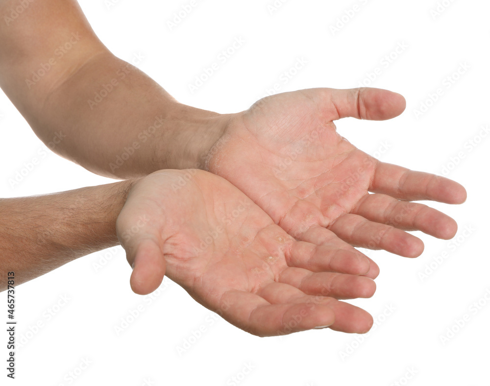 Man suffering from calluses on hands against white background, closeup Man suffering from calluses on hands against white background, closeup