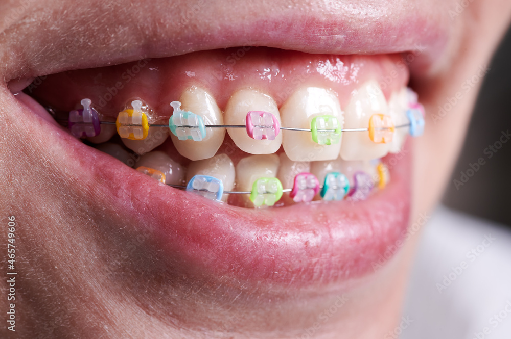 Close up of orthodontic braces with colorful O-rings on teeth. Woman  patient demonstrating dental brackets with multicolored rubber bands.  Concept of dentistry, orthodontics and stomatology. Photos | Adobe Stock
