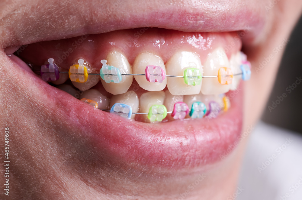 Close up of orthodontic braces with colorful O rings on teeth