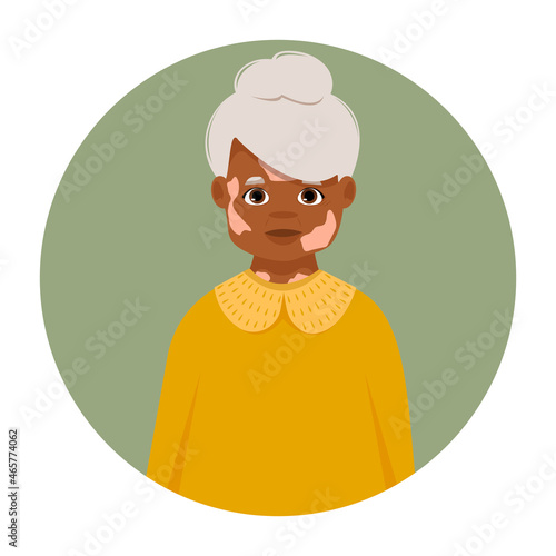 Avatar of vitiligo woman. Portrait of depigmentatate human. World vitiligo day. 
