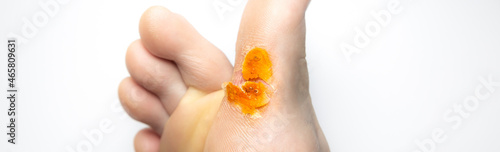 Contagious skin illness on foot. Medical treatment photo..Close up photo of plantar wart on man's foot. Salicylic acid plaster. Remove Verruca plantaris.